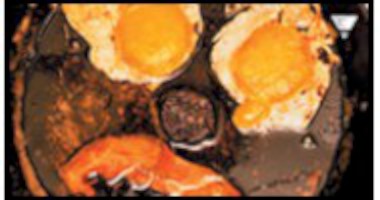 Varning f�r teflon